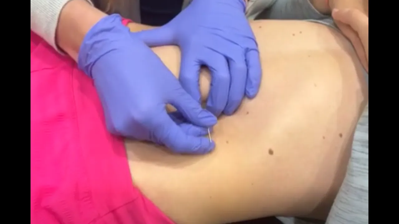 Dry Needling – What is it? (The Benefits of Dry Needling for Moms)